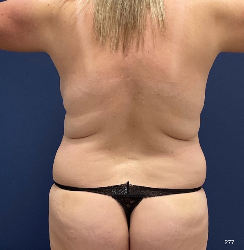 Tummy Tuck Before & After Gallery - Patient 115046 - Image 3
