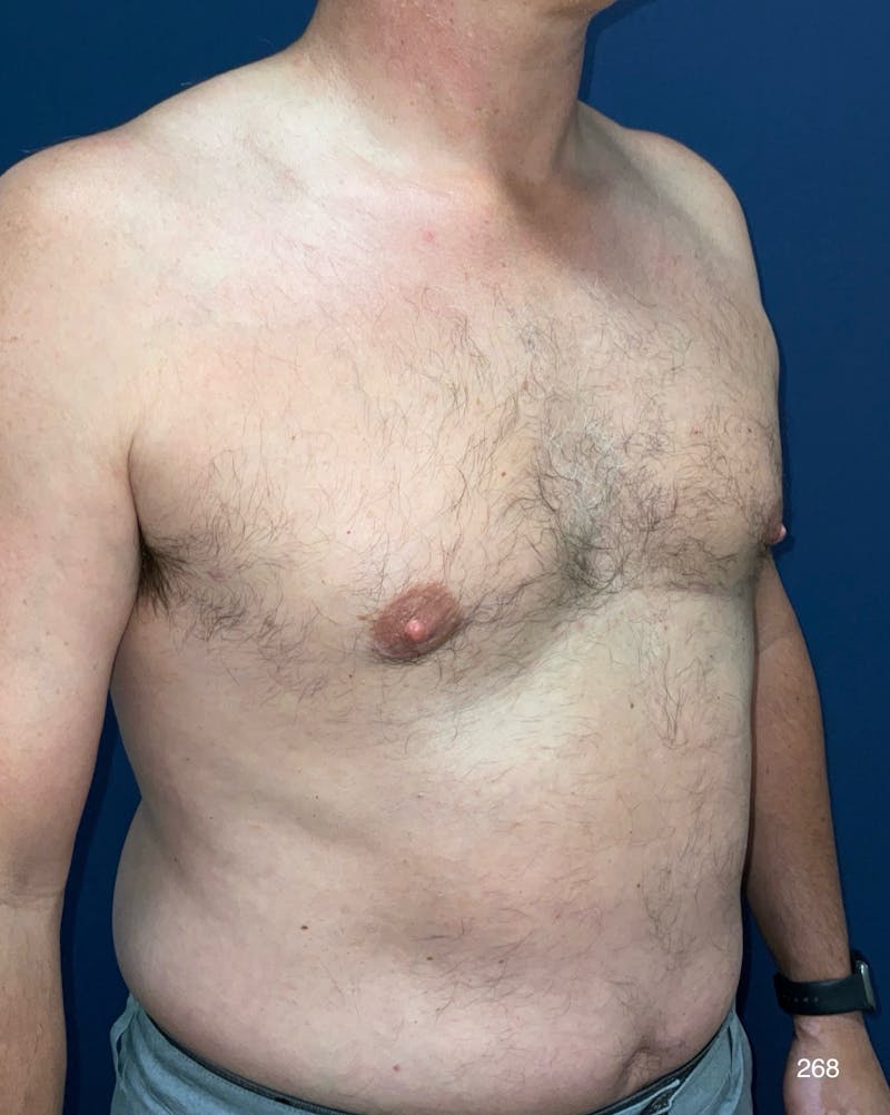 Gynecomastia Before & After Gallery - Patient 353059 - Image 4