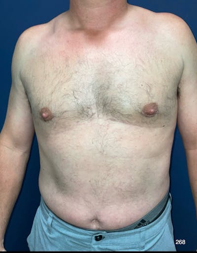 Gynecomastia Before & After Gallery - Patient 353059 - Image 2