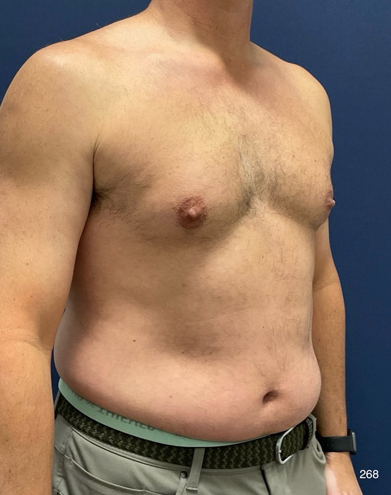 Gynecomastia Before & After Gallery - Patient 353059 - Image 3
