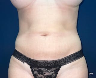 BodyTite/MorpheusBody Before & After Gallery - Patient 212820 - Image 2
