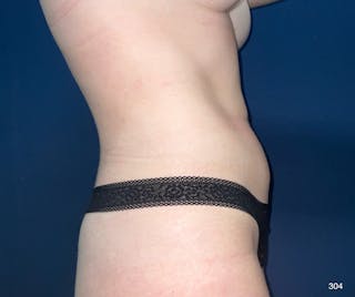 BodyTite/MorpheusBody Before & After Gallery - Patient 212820 - Image 6