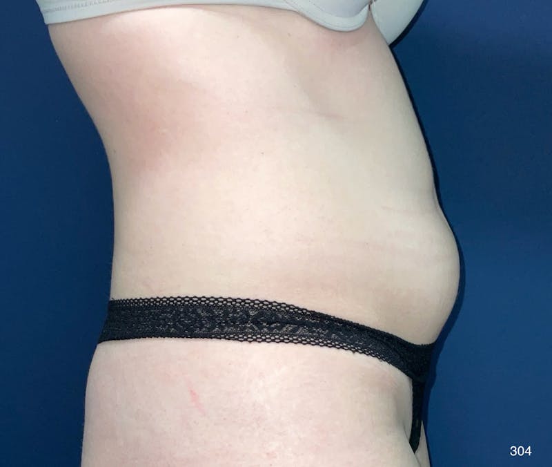 BodyTite/MorpheusBody Before & After Gallery - Patient 212820 - Image 5