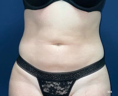 BodyTite/MorpheusBody Before & After Gallery - Patient 212820 - Image 1
