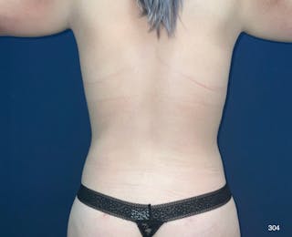 BodyTite/MorpheusBody Before & After Gallery - Patient 212820 - Image 8