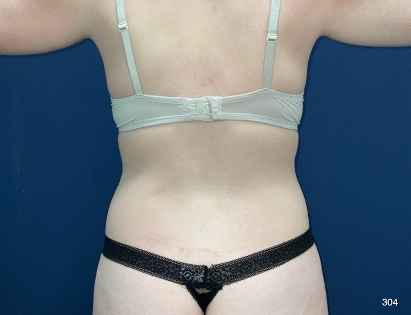 BodyTite/MorpheusBody Before & After Gallery - Patient 212820 - Image 7