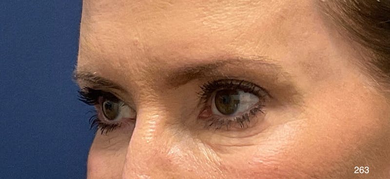 Blepharoplasty Before & After Gallery - Patient 154442 - Image 4