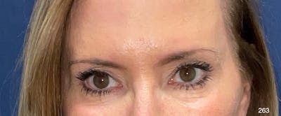 Blepharoplasty Before & After Gallery - Patient 154442 - Image 2