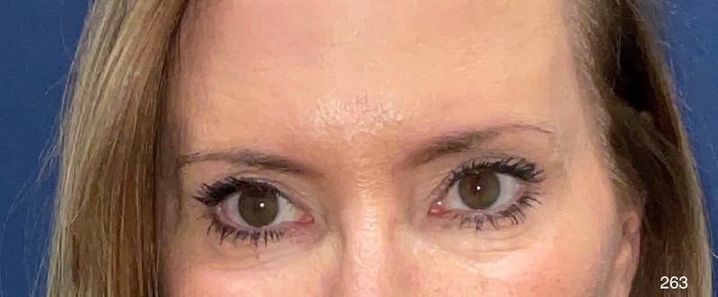 Blepharoplasty Before & After Gallery - Patient 154442 - Image 2