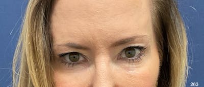 Blepharoplasty Before & After Gallery - Patient 154442 - Image 1