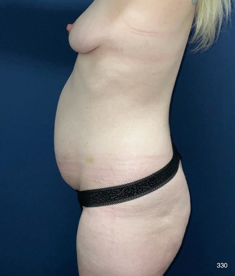 Tummy Tuck Before & After Gallery - Patient 164719 - Image 3