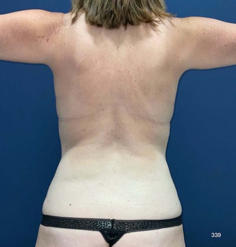 Tummy Tuck Before & After Gallery - Patient 314740 - Image 5