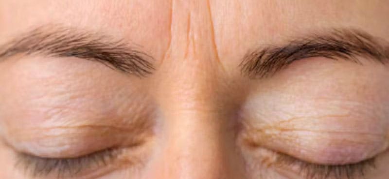 Wrinkle Relaxers Before & After Gallery - Patient 791993 - Image 1