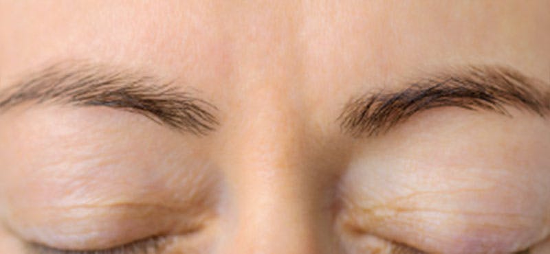Wrinkle Relaxers Before & After Gallery - Patient 791993 - Image 2