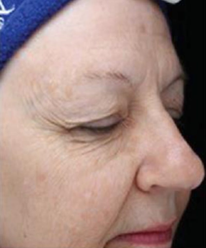 IPL Photofacial Before & After Gallery - Patient 224924 - Image 2