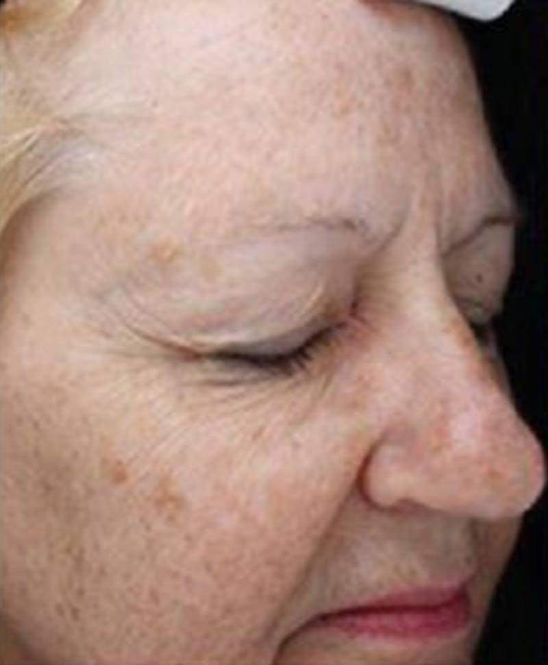 IPL Photofacial Before & After Gallery - Patient 224924 - Image 1