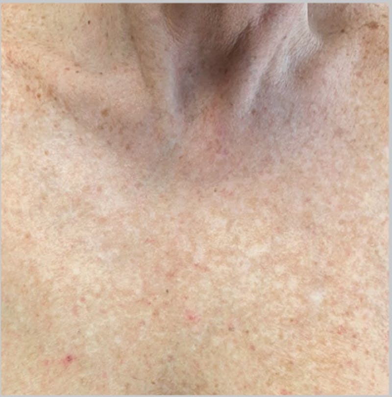 IPL Photofacial Before & After Gallery - Patient 420509 - Image 2