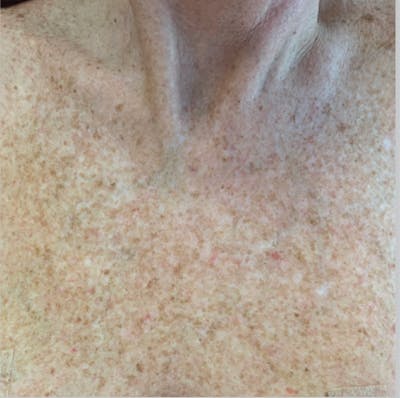 IPL Photofacial Before & After Gallery - Patient 420509 - Image 1