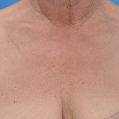 IPL Photofacial Before & After Gallery - Patient 163040 - Image 1