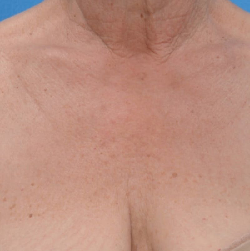 IPL Photofacial Before & After Gallery - Patient 163040 - Image 1