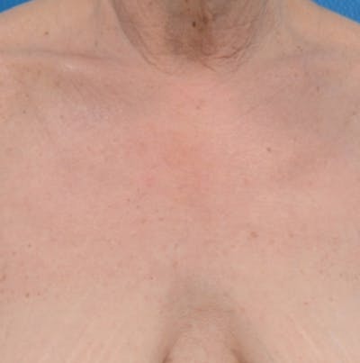 IPL Photofacial Before & After Gallery - Patient 163040 - Image 2