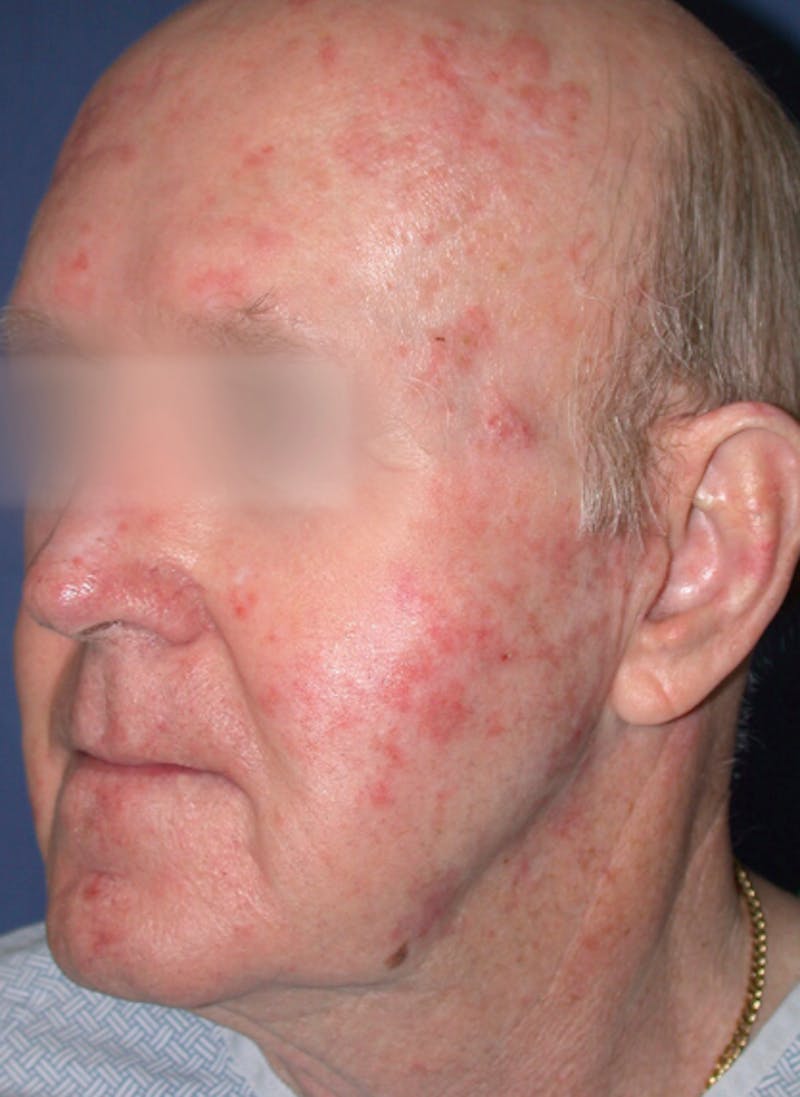 LaserPeel Before & After Gallery - Patient 356787 - Image 1