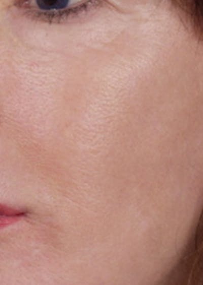 LaserPeel Before & After Gallery - Patient 398715 - Image 2