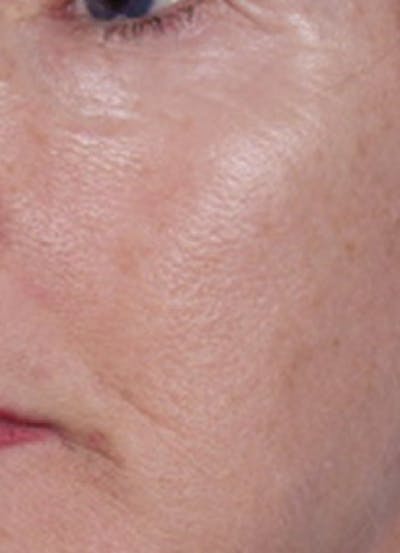 LaserPeel Before & After Gallery - Patient 398715 - Image 1