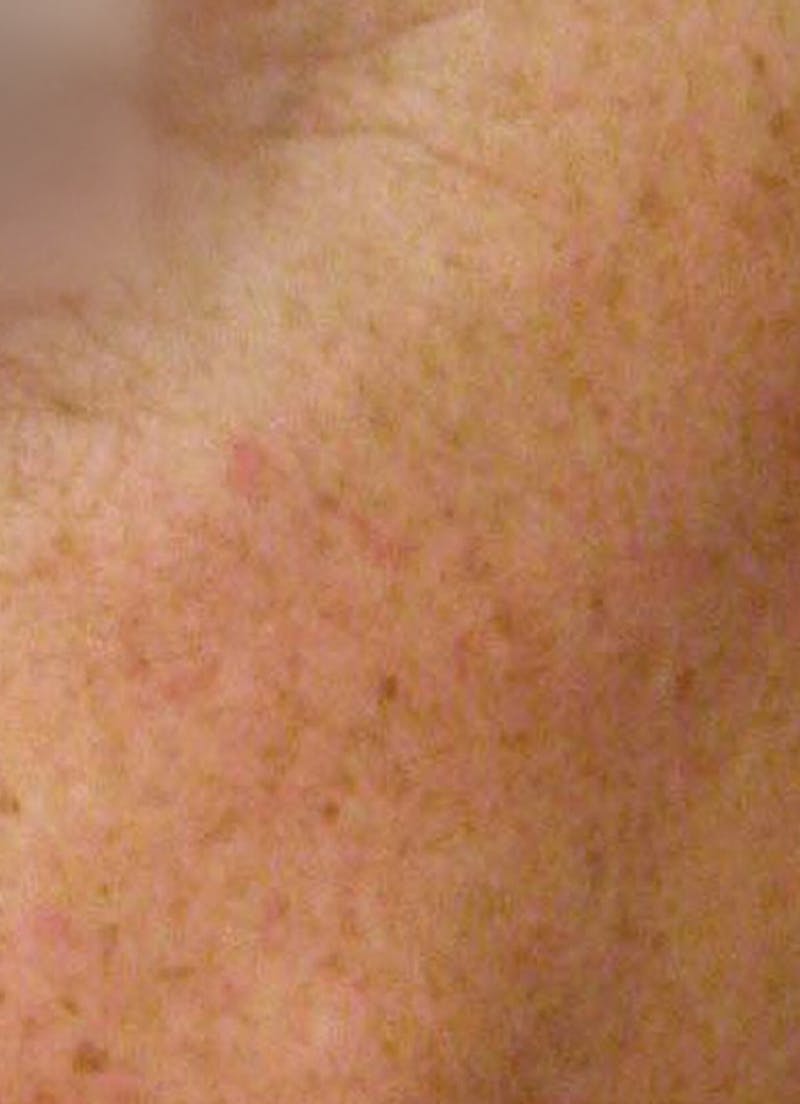 LaserPeel Before & After Gallery - Patient 367376 - Image 2