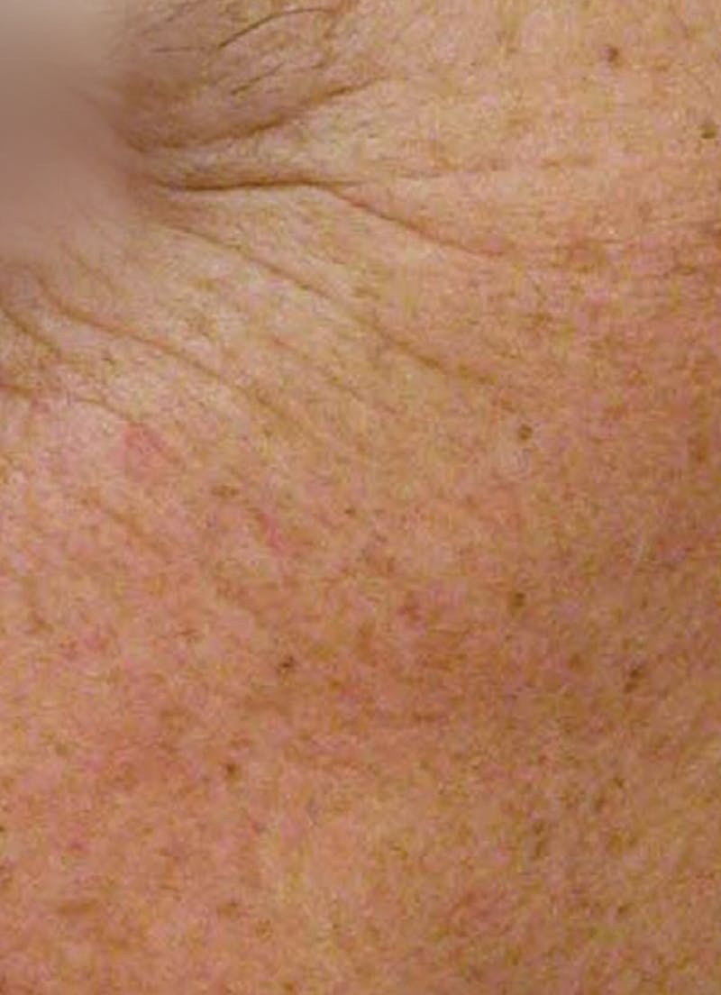 LaserPeel Before & After Gallery - Patient 367376 - Image 1
