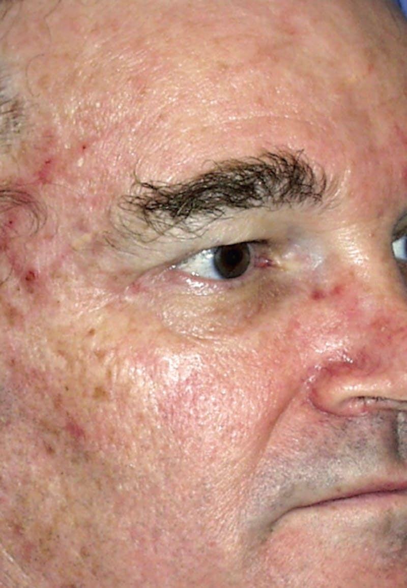 LaserPeel Before & After Gallery - Patient 360612 - Image 1