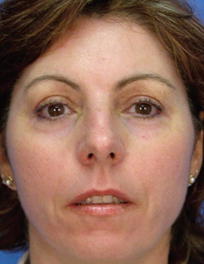 LaserPeel Before & After Gallery - Patient 579532 - Image 2