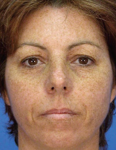 LaserPeel Before & After Gallery - Patient 579532 - Image 1
