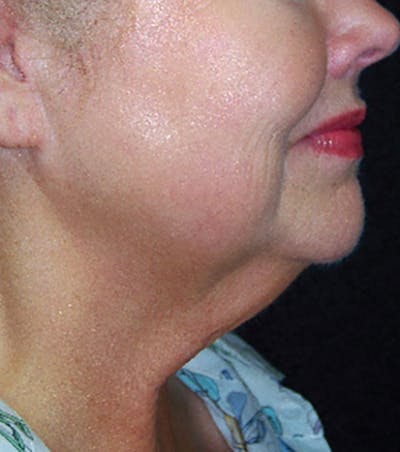 Skin Tightening Before & After Gallery - Patient 267063 - Image 2