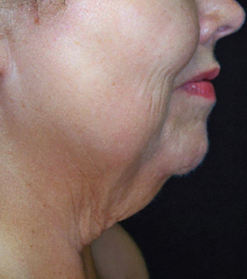 Skin Tightening Before & After Gallery - Patient 267063 - Image 1