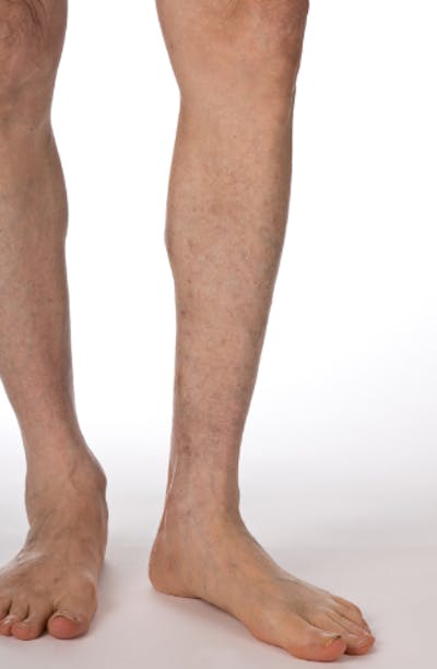 Vein Treatments Before & After Gallery - Patient 174384 - Image 2