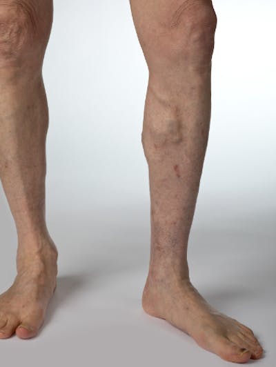 Vein Treatments Before & After Gallery - Patient 174384 - Image 1