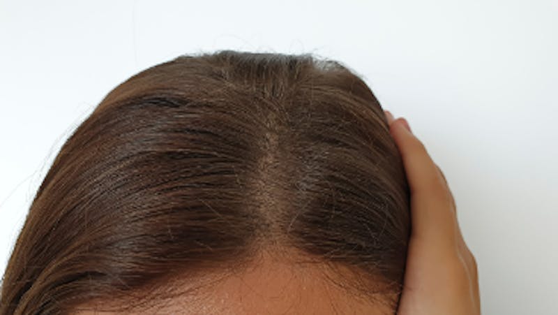 Hair Restoration Before & After Gallery - Patient 685675 - Image 1