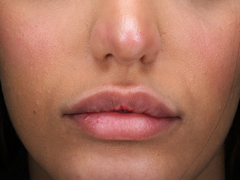 Lip Filler Before & After Gallery - Patient 294574 - Image 1