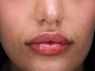 Lip Filler Before & After Gallery - Patient 294574 - Image 2