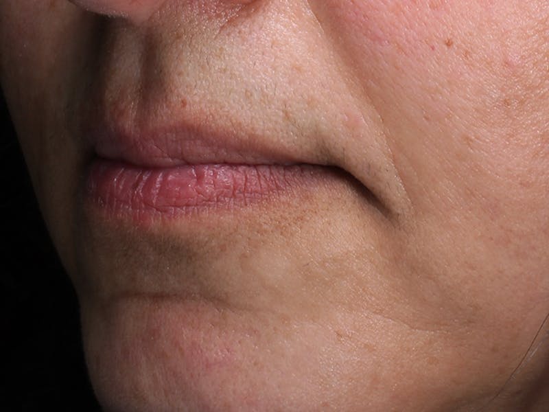 Lip Filler Before & After Gallery - Patient 251166 - Image 1