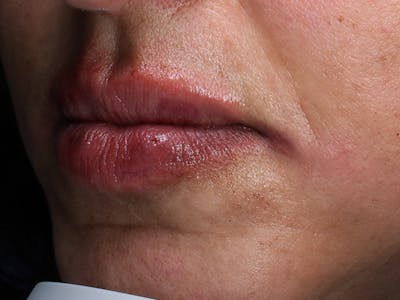 Lip Filler Before & After Gallery - Patient 251166 - Image 2