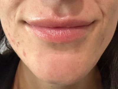 Lip Filler Before & After Gallery - Patient 406886 - Image 1