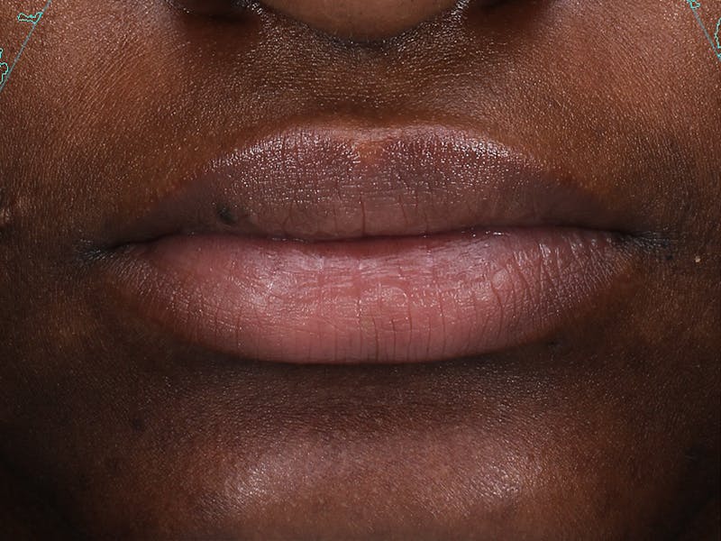 Lip Filler Before & After Gallery - Patient 210207 - Image 1