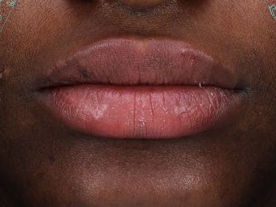 Lip Filler Before & After Gallery - Patient 210207 - Image 2