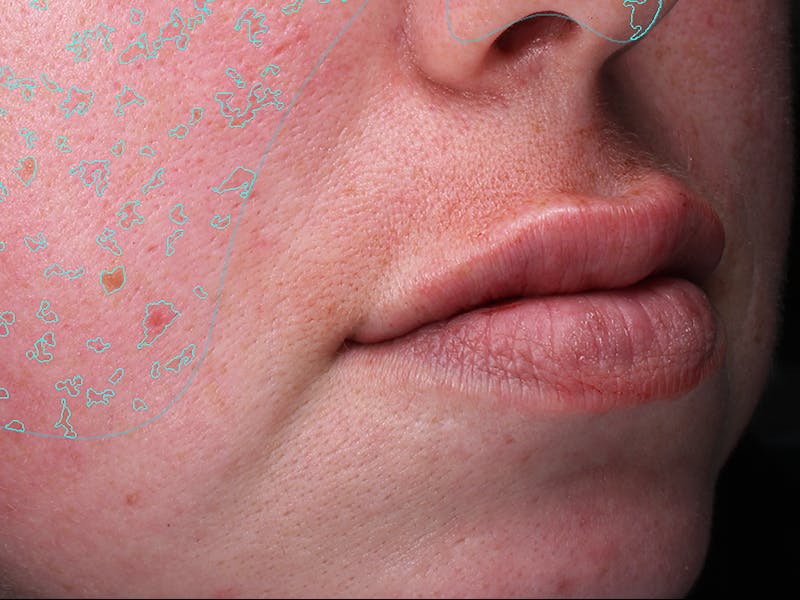 Lip Filler Before & After Gallery - Patient 255445 - Image 2