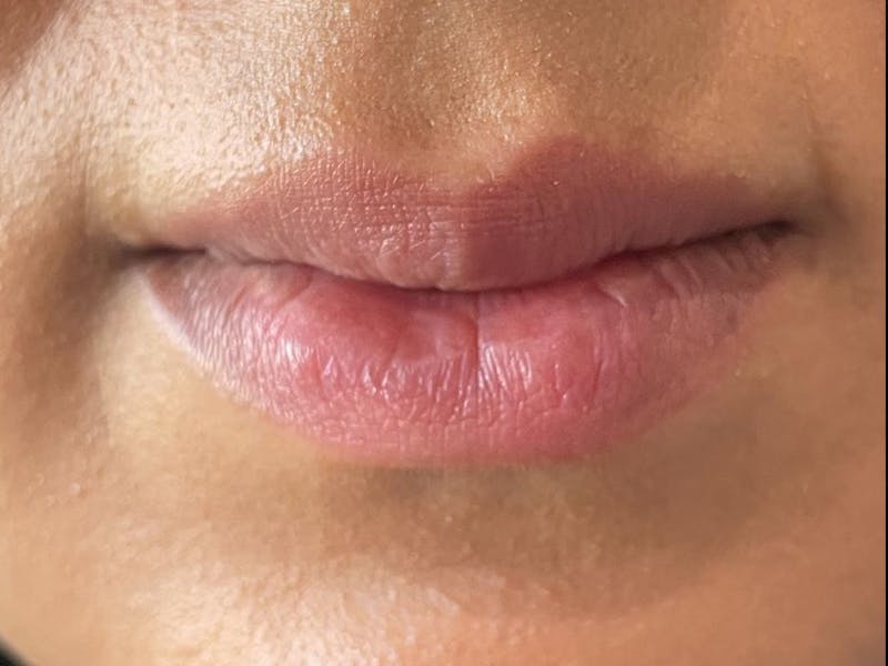 Lip Filler Before & After Gallery - Patient 331087 - Image 1