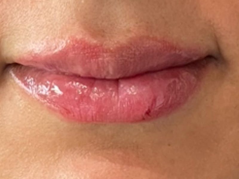 Lip Filler Before & After Gallery - Patient 331087 - Image 2