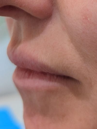 Lip Filler Before & After Gallery - Patient 373879 - Image 1
