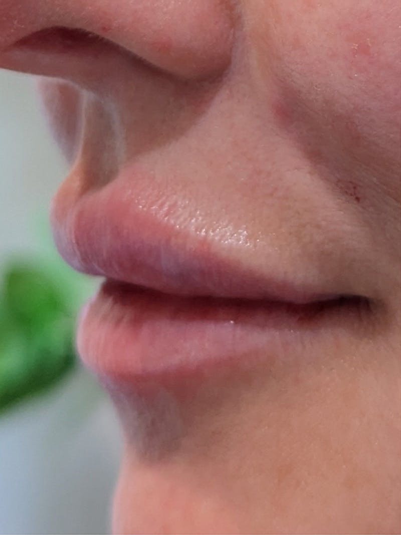 Lip Filler Before & After Gallery - Patient 373879 - Image 2